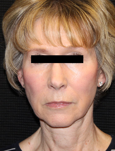 Patient #69932: Facelift & Fat Injections Before Image