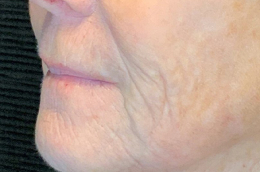 Patient #19055: 3 For Me Refresh After Image