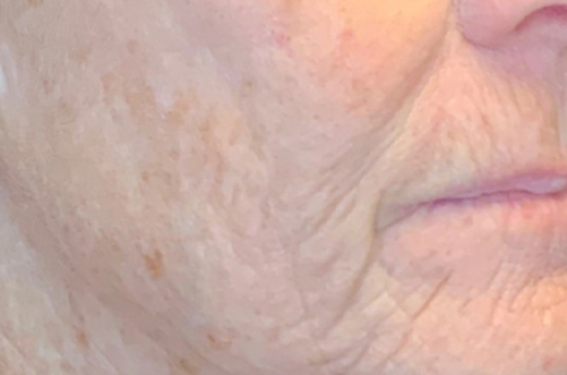 Patient #19055: 3 For Me Refresh After Image