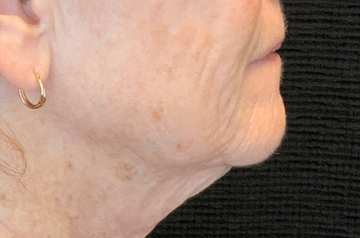 Patient #19055: 3 For Me Refresh After Image