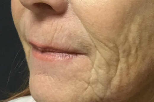 Patient #19055: 3 For Me Refresh Before Image