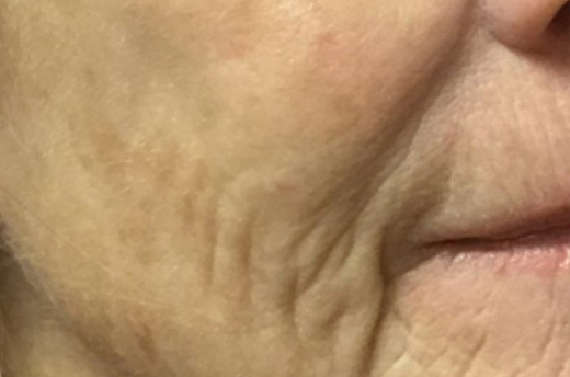 Patient #19055: 3 For Me Refresh Before Image