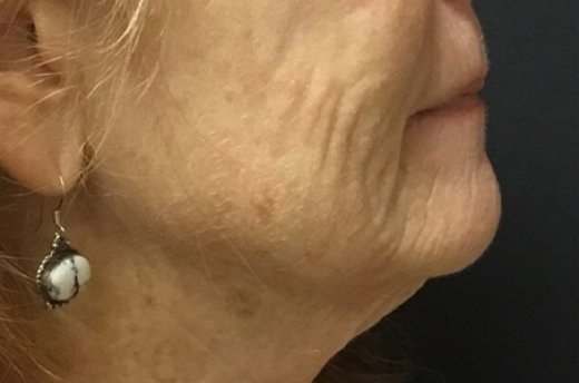 Patient #19055: 3 For Me Refresh Before Image