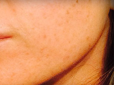 Patient #79995: Resurfacing After Image