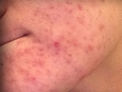 Patient #79995: Resurfacing for Acne Scarring Before Image