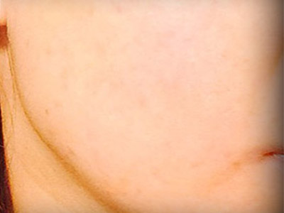 Patient #79995: Resurfacing After Image