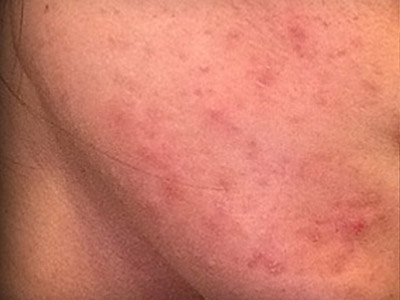 Patient #79995: Resurfacing Before Image