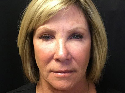 Patient #80493: BOTOX After Image