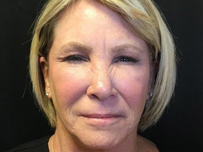 Patient #80493: BOTOX Before Image