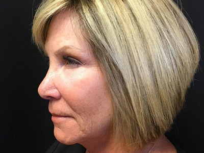 Patient #80493: BOTOX After Image