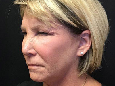 Patient #80493: BOTOX Before Image