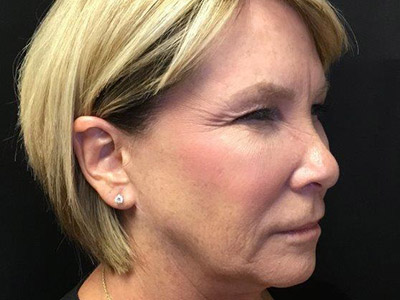 Patient #80493: BOTOX Before Image