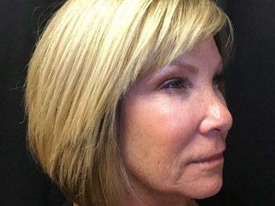 Patient #80493: BOTOX After Image