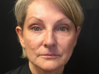 Patient #75216: BOTOX After Image