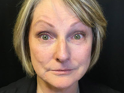 Patient #75216: BOTOX Before Image