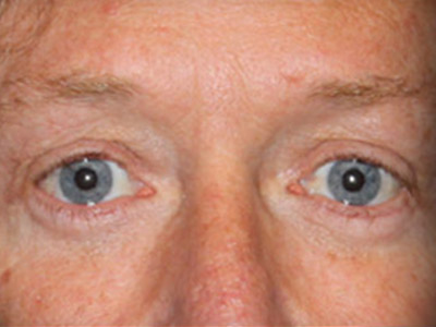Patient #26255: Blepharoplasty After Image