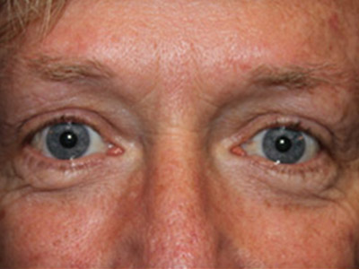 Patient #26255: Blepharoplasty Before Image