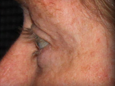Patient #26255: Blepharoplasty After Image