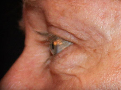 Patient #26255: Blepharoplasty Before Image