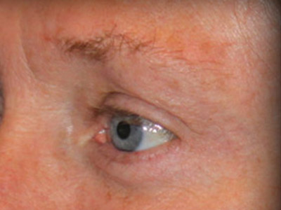 Patient #26255: Blepharoplasty After Image