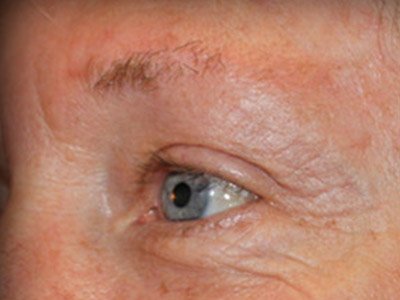 Patient #26255: Blepharoplasty Before Image