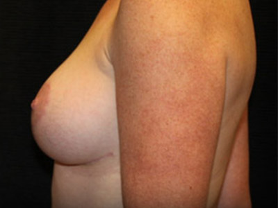Patient #81074: Breast Augmentation & Breast Lift After Image