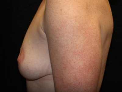 Patient #81074: Breast Augmentation & Breast Lift Before Image