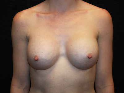 Patient #46749: Breast Augmentation After Image