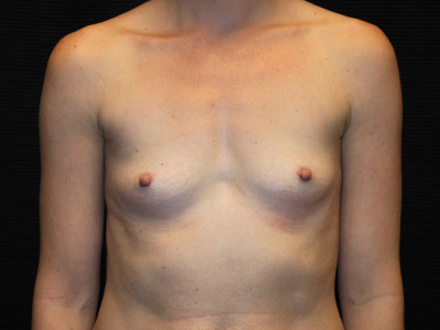 Patient #46749: Breast Augmentation Before Image