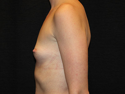 Patient #46749: Breast Augmentation Before Image