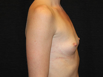 Patient #46749: Breast Augmentation Before Image