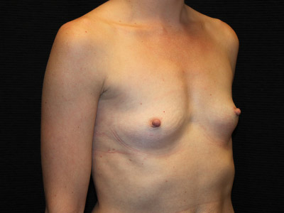 Patient #46749: Breast Augmentation Before Image
