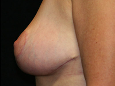 Patient #09980: Breast Lift After Image
