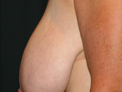 Patient #09980: Breast Lift Before Image