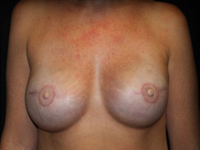 Patient #90864: Breast Reconstruction After Image