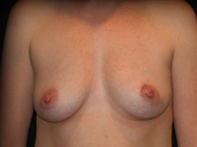 Patient #90864: Breast Reconstruction Before Image