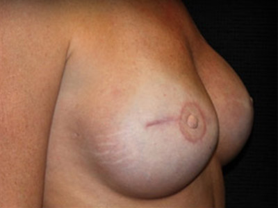 Patient #90864: Breast Reconstruction After Image