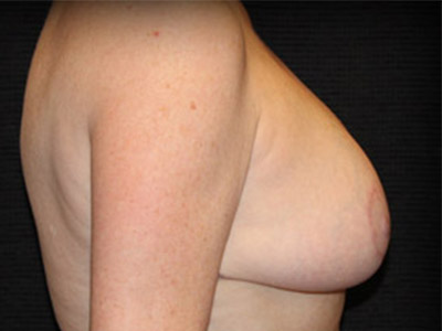 Patient #91154: Breast Reduction After Image