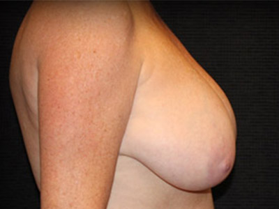 Patient #91154: Breast Reduction Before Image