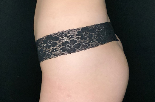 Patient #44093-1: Liposuction to Abdomen & Flanks After Image