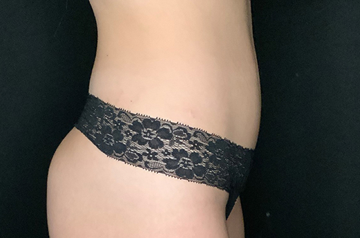 Patient #44093-1: Liposuction to Abdomen & Flanks After Image