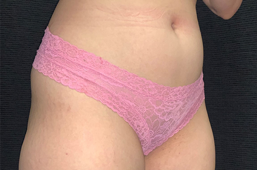 Patient #44093-1: Liposuction to Abdomen & Flanks Before Image