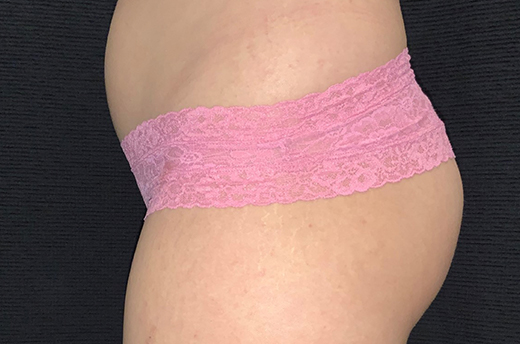 Patient #44093-1: Liposuction to Abdomen & Flanks Before Image