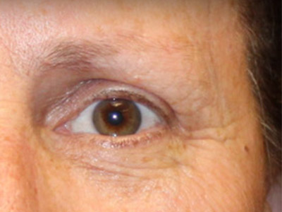 Patient #49027: Brow Lift After Image