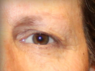 Patient #49027: Brow Lift Before Image