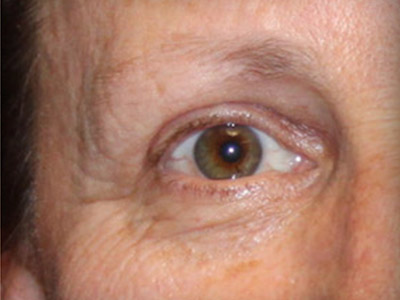 Patient #49027: Brow Lift After Image
