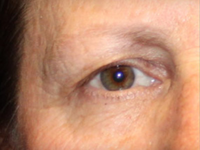 Patient #49027: Brow Lift Before Image