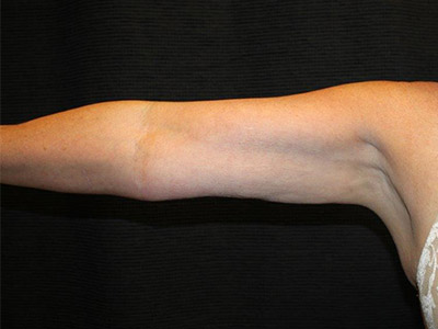 Patient #95724: CoolSculpting After Image