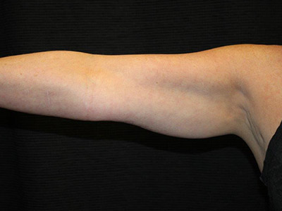 Patient #95724: CoolSculpting Before Image