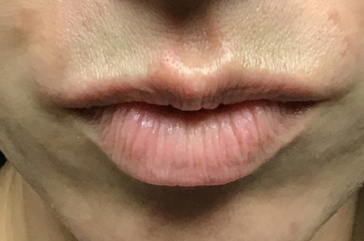 Patient #54162: Dysport After Image